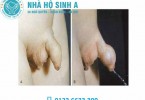 hình ảnh hẹp bao quy đầu